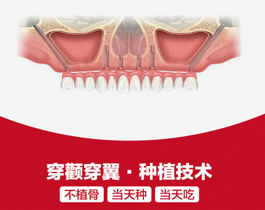 穿顴穿翼種植是否屬於專利壟斷技術？深圳鵬程口腔醫師團隊熟練開展該項高難度種植