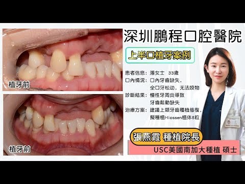 穿顴穿翼種植牙術後注意事項｜深圳鵬程口腔高難種植術後護理須知
