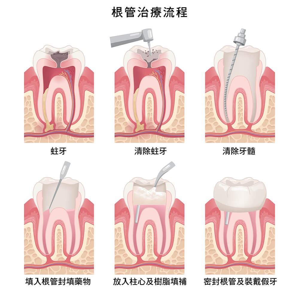 微創根管治療流程 | 深圳鵬程口腔連鎖.jpg