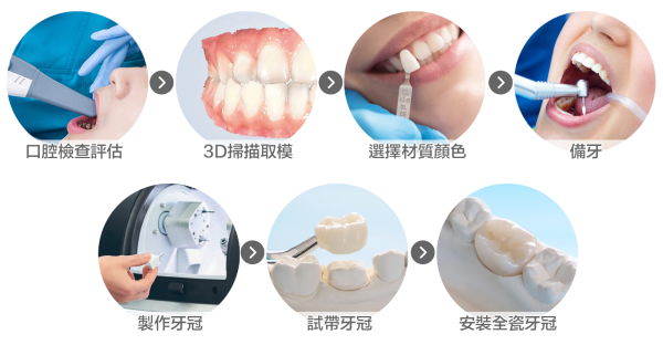 金屬牙VS金屬牙冠邊款好 | 詳解牙冠材質品牌特點