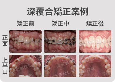深覆合矯正案例 矯正前中後對比