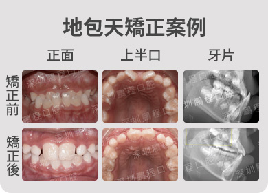 地包天矯正案例 矯正前後對比