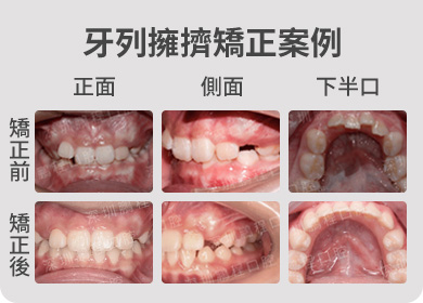 牙列擁擠矯正案例 矯正前後對比