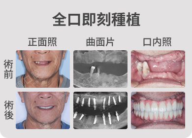 全口即刻種植案例 術前術後對比