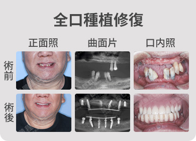 全口種植修復案例 術前術後對比