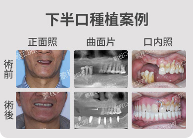 下半口種植案例 術前術後對比